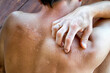 © SkyLine - The dry and itching man's skin after sunbath