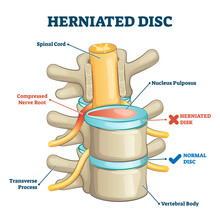 Herniated Disc Injury 3D Side View On Spine Bone Skeleton Vector Illustration