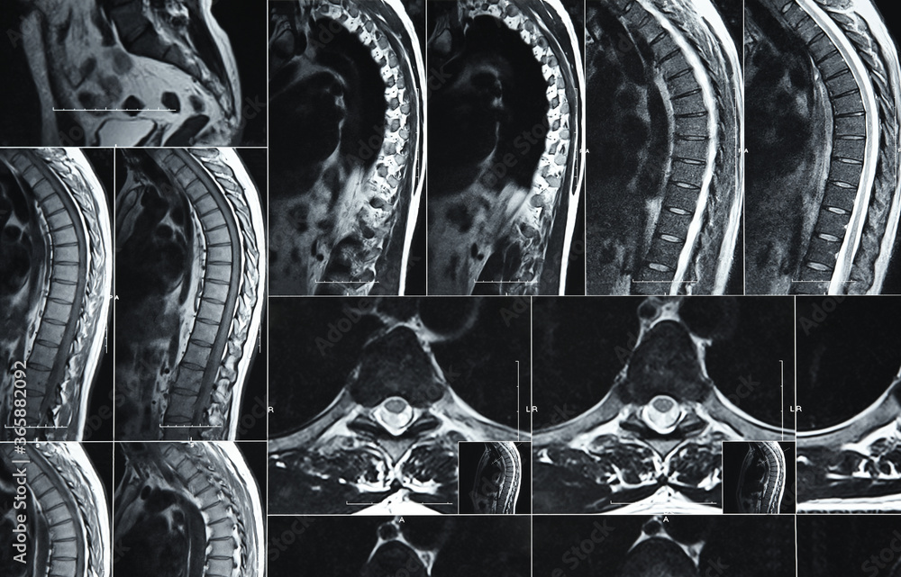 MRI or CT scan of human lumbar spine Stock Photo | Adobe Stock