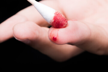 Wall Mural - Use a cotton swab to wipe the blood at the wound on fingertips that are bleeding on dark background.