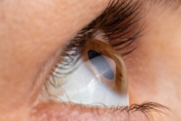 Keratoconus of eye, 4th degree. Contortion of the cornea in the form of a cone, deterioration of vision, astigmatism. Macro close up