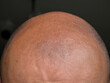 © Cristi - Human hair loss concept. Close up detail with a human head bald with alopecia.