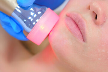 Portrait of woman on apparatus phonophoresis face procedure with hyaluronic acid gel in cosmetology clinic, closeup chin. Cosmetologist beautician doctor is moving manipula with red light on face.