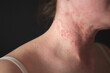 the girl has dermatitis on the neck on a black background