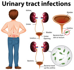 Canvas Print - Informative illustration of urinary tract infections