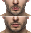 Result of a jawline reshape