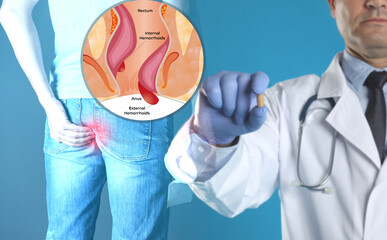 Wall Mural - Doctor holding suppository near man suffering from hemorrhoid pain. Illustration of unhealthy lower rectum