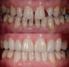 The Natural-looking Smile Makeover With The Dental Ceramic Veneer And Crown