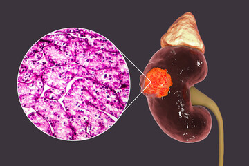 Wall Mural - Kidney cancer, illustration and light micrograph