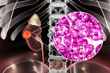 Wall Mural - Kidney cancer, illustration and light micrograph