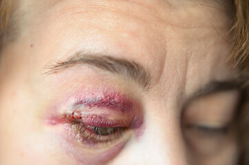 Close-up photograph of a closed woman's eye with traces of eyelid surgery.