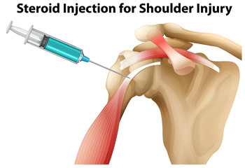 Canvas Print - Steroid Injection for Shoulder Injury