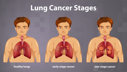 Poster - Informative illustration of lung cancer stages