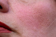 close up of ageing skin with pitted marks from acne scars 