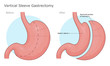 Vertical sleeve gastrectomy surgery illustration