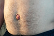 Umbilical hernia. Men's belly with a large bulging belly button