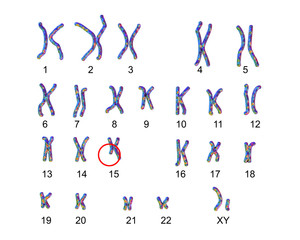 Wall Mural - Karyotype of Angelman syndrome