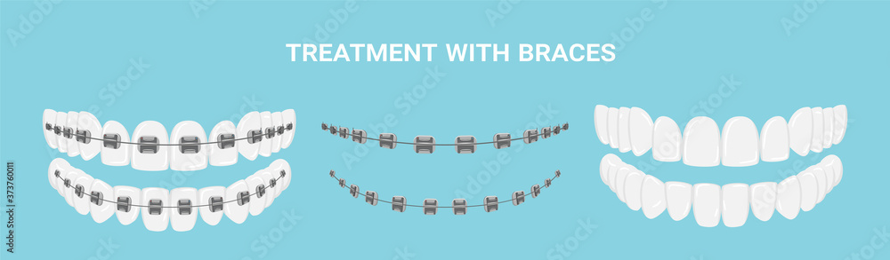 Teeth with or without braces. Arch braces without teeth. Orthodontic ...