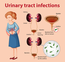 Canvas Print - Informative illustration of urinary tract infections