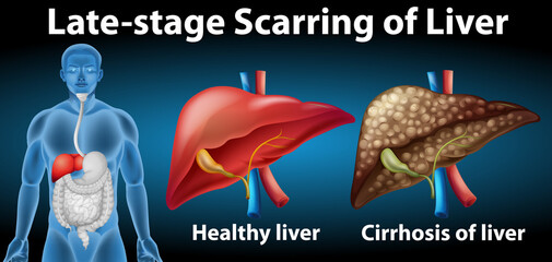 Poster - Late-stage scarring of liver