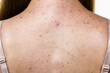 © Voyagerix - Woman with skin problem acne on back