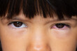 Conjunctivitis in a girl's eye as a possible symptom of coronavirus infection
