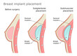Breast implant placement diagram. Subglandular and submuscular placement types. Plastic surgery of breast implants. 