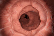 3D Illustration of a gastrointestinal polyp during Entersocopy