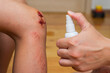 Woman sprays an antiseptic agent on the wound on the child?s knee. Treatment the wound. First Aid
