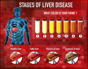 Poster - Stages of liver disease