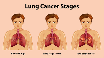 Poster - Informative illustration of lung cancer stages