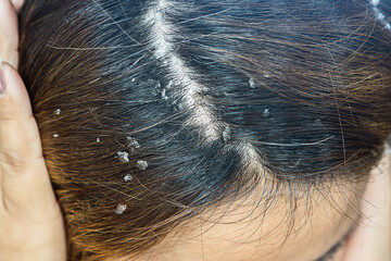 closeup hair with dandruff scalp, Seborrheic Dermatitis 