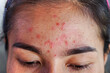 closeup acne on forehead of Asian woman teen, face with rash skin allergic to cosmetics   
