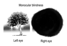 Patterns Of Visual Field Defects Are Sign And Symtomp Of Loss Of Vision Which Are Derived From Brain Lesion And Optic Nerve Lesion.