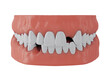 © 3d_vicka - jaw with missing front upper tooth deuce and lower tooth three on white background, 3d render