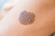 © Pixel-Shot - Birthmark on human skin, closeup
