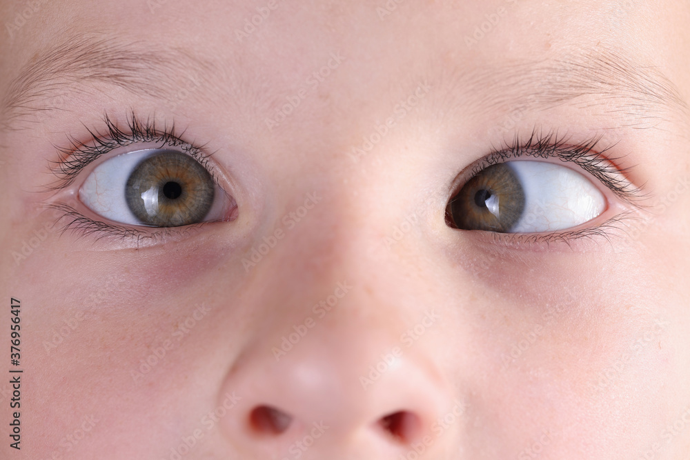 Child's face with squint and freckles on nose. Strabismus in children causes and treatment concept - obrazy, fototapety, plakaty 