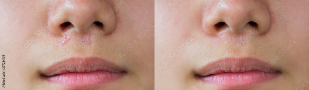 Image before and after laser treatment of keloid scar caused by accident in children, skin imperfections. Hypertrophic Scar on skin, dermatology and cosmetology concept. - obrazy, fototapety, plakaty 