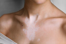 Closeup Of A Woman With Vitiligo