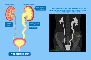 Canvas Print - kidney damage UTI scan test tube VCUG acute VUR cyst exam flow pain birth block blood fetal fetus renal stone tract treat tumor urine x-ray cancer defect pelvic pelvis reflux sample system enlarge