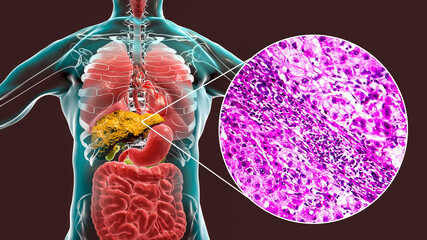 Wall Mural - Liver with cirrhosis inside human body