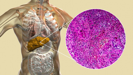 Wall Mural - Liver with cirrhosis inside human body