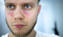 Man Suffers From Systemic Lupus Erythematosus, Age Spots Of Redness On The Face, A Rash.
