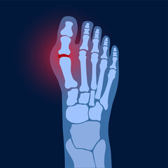 Wall Mural - Arthritis foot concept