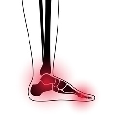 Sticker - Arthritis foot concept