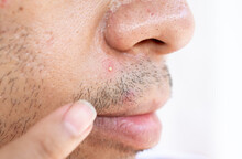 Close-up Shot Of A Whitehead Acne Occur On Men's Skin. A Whitehead Is A Type Of Acne That Forms When Oil, And Bacteria Become Trapped Within One Of Your Pores.