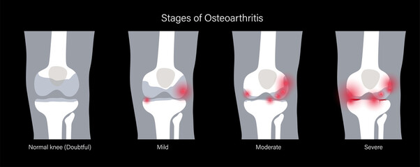 Wall Mural - Arthritis in knee joint