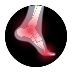 Sticker - Arthritis foot concept