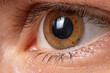 Macro eye photo. Keratoconus - eye disease, thinning of the cornea in the form of a cone. The cornea plastic