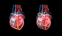 Anatomy Of The Human Heart, The Yellow Lines Demonstrating The Electrical (conduction) System Of The Heart. On The Righten Side An Irregular Heartbeat / Arrythmia / Atrial Fibrillation Is Shown.